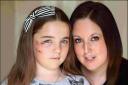 SCARRED: Lucie, 10, with mum Emily Leach and, right, after the attack
